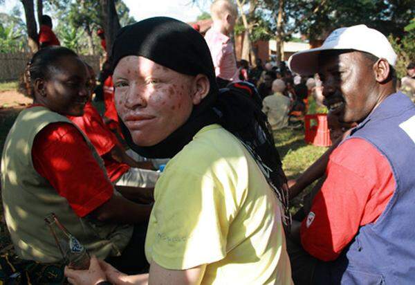 Der Handel damit ist in Tansania ein Riesengeschäft. Finger, Augen, Haare oder auch nur ein Stück Haut bringen den Mördern mehr Geld ein, als sie sonst in einem Monat verdienen. Ein Albinokörper bringt bis zu 300.000 Euro.