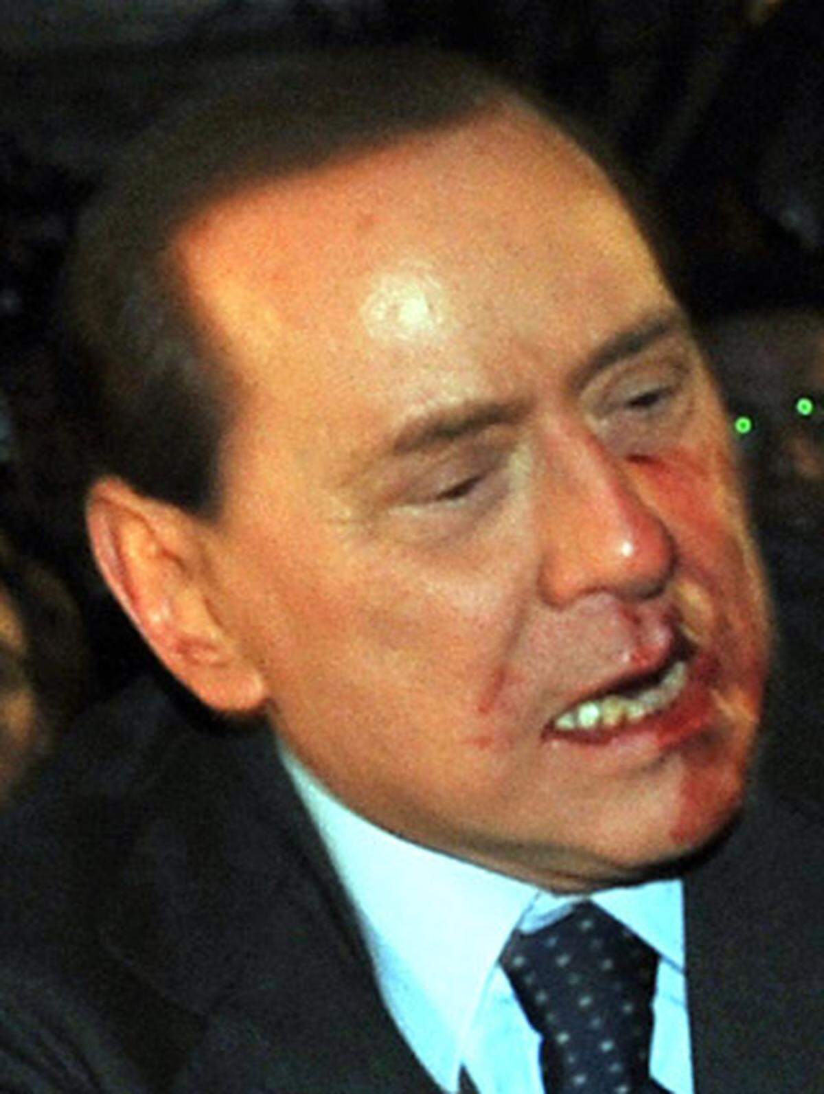 Berlusconi erleidet einen Nasenbeinbruch und Verletzungen an der Lippe. Außerdem brechen zwei Zähne ab.