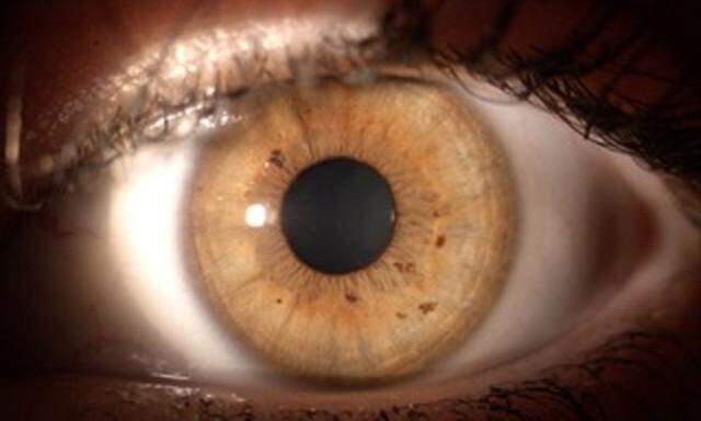 Sommersprossen sind auf der Iris eines Auges zu erkennen.