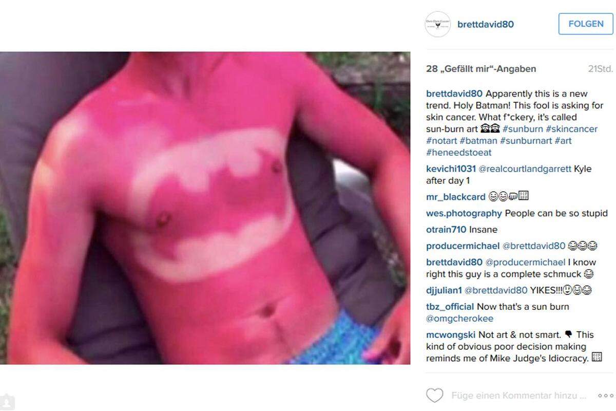 Wer glaubt, dass die Zeiten vorbei sind, in denen der Sonnenbrand noch als Amuse-Gueule der "gesunden Bräune" galt, liegt nicht ganz richtig. Der vielleicht dümmste Trend des Instagram-Sommers 2015 hieß "Sunburn Art", der Sonnenanbeter dazu ermunterte, sich lustige Motive in die Haut zu brennen.