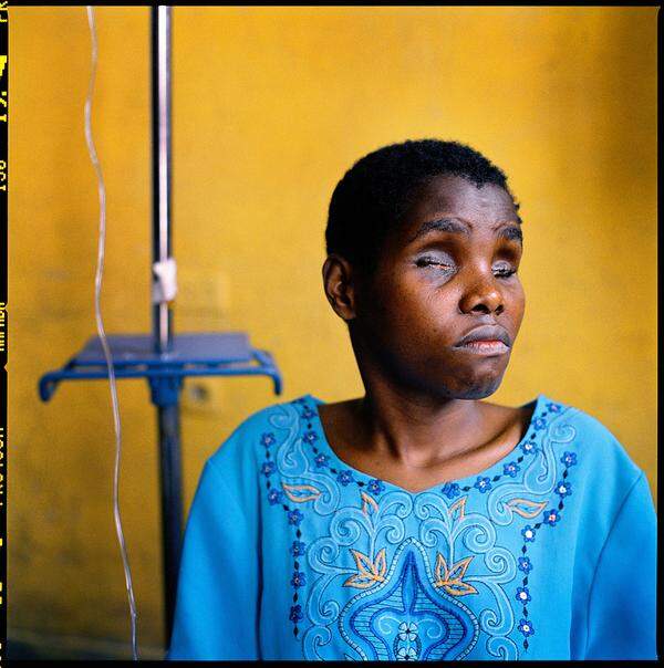 Robin Hammond, Neuseeland: "Rape - a Weapon of War 05"Der 22-Jährigen Basemae Maombi wurden die Augen herausgeschnitten, nachdem sie einen ihrer Vergewaltiger erkannt hatte und seinen Namen rief, um ihn aufzuhalten. Fotograf Robin Hammond hat im Kongo Vergewaltigungsopfer fotografiert, mehr als eine halbe Million Frauen und Kinder wurden während des Krieges vergewaltigt. Der Kongo gilt als "Vergewaltigungs-Hochburg der Welt". Die UNO hat sexuelle Gewalt erst vor kurzem als Kriegsverbrechen eingestuft.  2. Platz in dieser Kategorie