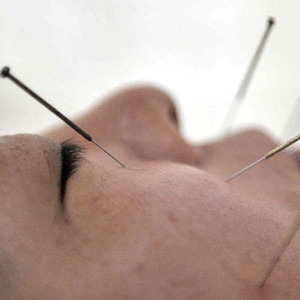 CHINA ACUPUNCTURE