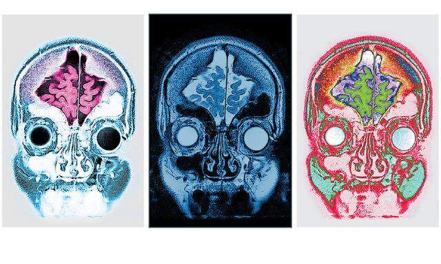 Bildgebende Verfahren wie etwa die Magnetresonanztomografie werden zunehmend von künstlicher Intelligenz verarbeitet, um die Diagnose zu erleichtern.