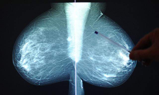 Symbolbild einer Mammografie