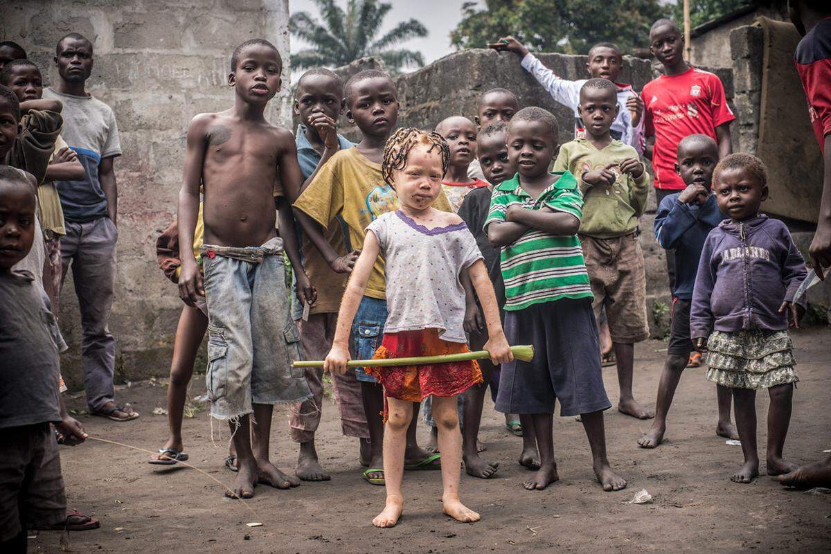 Ein Kind mit Albinismus stellt sich selbstbewusst zwischen andere Kinder im kongolesischen Kinshasa und schaut in die Kamera von Fotografin Patricia Willocq. Menschen mit Albinismus werden in Tansania, Kenia und auch im Kongo angestarrt, ausgelacht, ausgegrenzt, verfolgt - und manchmal auch umgebracht.