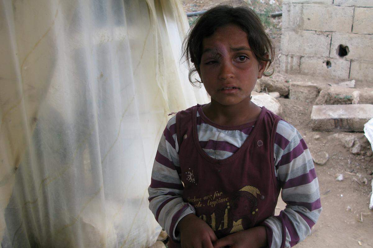 Das ist Ritage. Die Achtjährige wurde im syrischen Hama von einem Granatsplitter getroffen. Die Wunde hat sich infiziert.