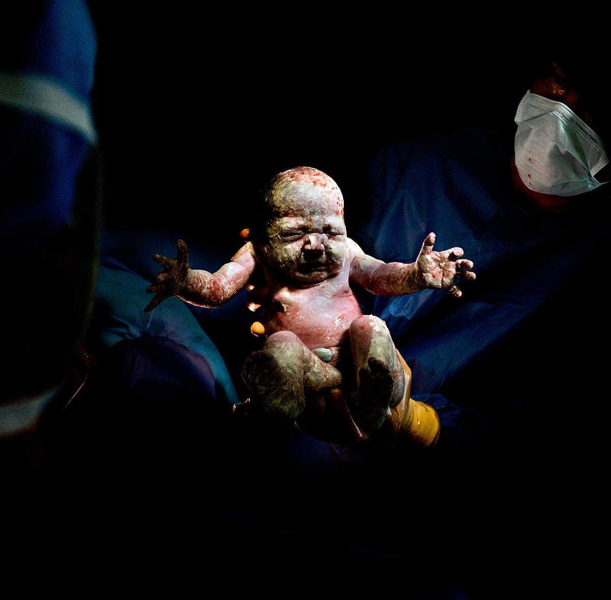 Christian Berthelot, Frankreich: "Caesar #19".Berthelot fotografiert Babys, die via Kaiserschnitt zur Welt gekommen sind. Der Titel der Serie "Caesar" bezieht sich auf den englischen Begriff für Kaiserschnitt: Caesarean section.