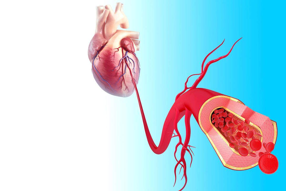 Die zugrunde liegende Atherosklerose, die Verdickung, Verh&auml;rtung oder Verkalkung der Arterienwand, entwickelt sich schleichend und ist bei Auftreten der ersten Symptome meist weit fortgeschritten.