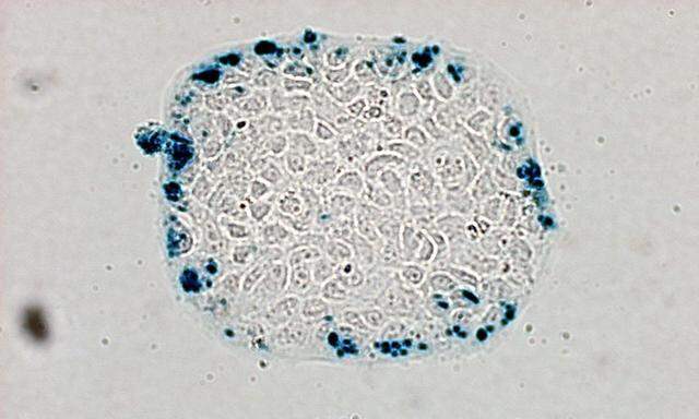 Symbolbild: Krebszelle