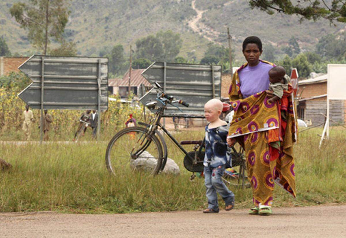 Dass es Albinos in Afrika schwer haben, ist nicht neu: Früher wurden die hellhäutigen, weißhaarigen Menschen oft schon nach der Geburt umgebracht. Man glaubte, die Albinos seien verflucht. Seit etwa einem Jahr nehmen Übergriffe auf Albinos wieder stark zu.