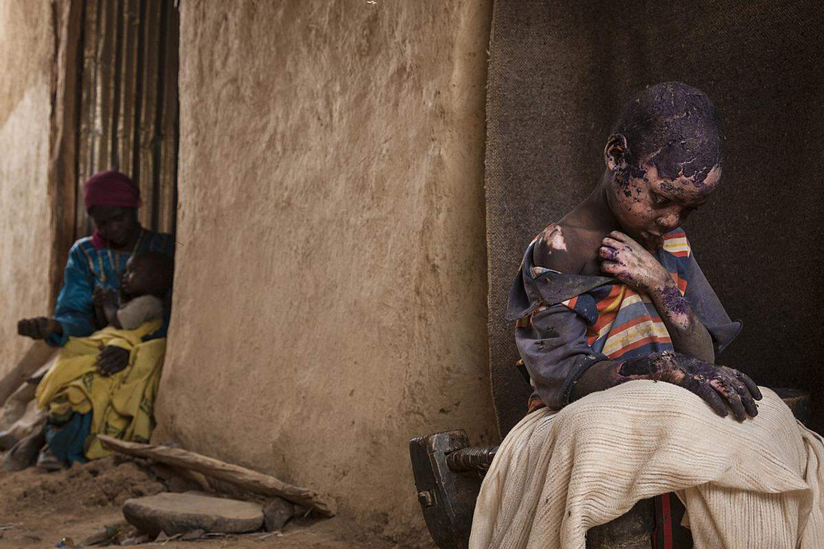 Adriane Ohanesian, USA, 2015, The Forgotten Mountains of Sudan Der siebenjährige Adam Abdel wurde in Burgu, Darfur, schwer verbrannt, als eine Bombe auf das Haus seiner Familie geworfen wurde. In Darfur kämpfen seit 2003 Rebellengruppen gegen die sudanesische Armee. 