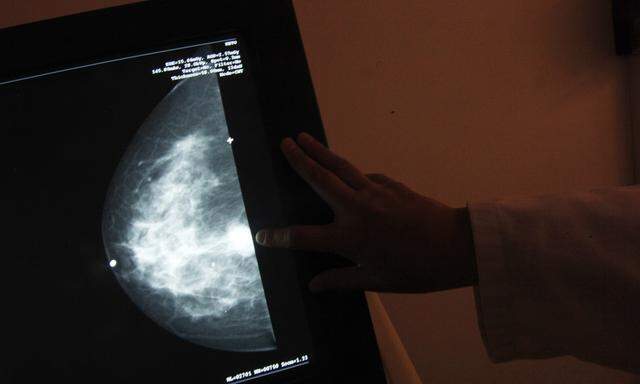 Die tödlichsten Krebserkrankungen waren Brust-, Luftröhren-, Lungen-, Darm- und Magenkrebs. (Symbolbild)