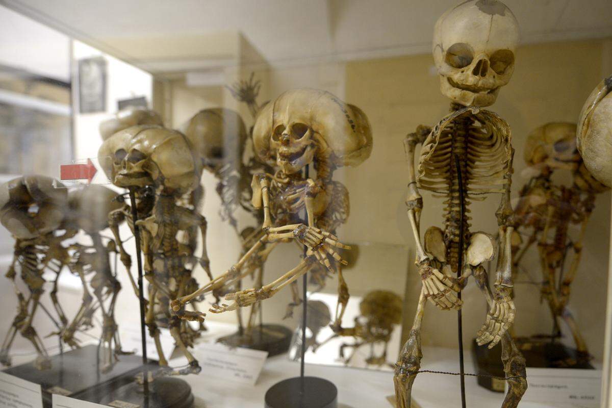 Wachspräparate von durch Krankheiten entstellten Körperteilen, eingelegte Organe und verkümmerte Skelette - 50.000 Präparate kranker oder entstellter menschlicher Körperteile und Organe umfasst die Pathologisch-anatomische Sammlung des Naturhistorischen Museums (NHM) im Narrenturm im Alten AKH in Wien.