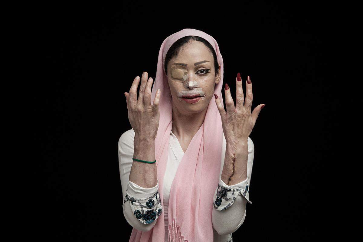 Am Donnerstagabend wurden in London die Sieger des Sony World Photography Award gekürt. Der Hauptpreis, die L'Iris d'Or, geht heuer an den iranischen Fotografen Asghar Khamseh, der auch die Kategorie "Aktuelle Themen" für sich entschieden hat. "Feuer des Hasses" heißt seine Fotoserie. Er porträtierte die Opfer von Säureattentaten im Iran. Shirin Mohamadi, 18 Jahre alt, hatte einen Verehrer abgewiesen. Am Neujahrstag 2012 überschüttete er sie mit Säure. Sie verlor ein Auge und ihre Nase, andere Teile ihres Körpers wurden schwer verletzt. Sie wurde mehrfach operiert.