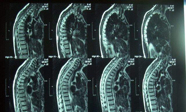 Röntgenbild Wirbelsäule