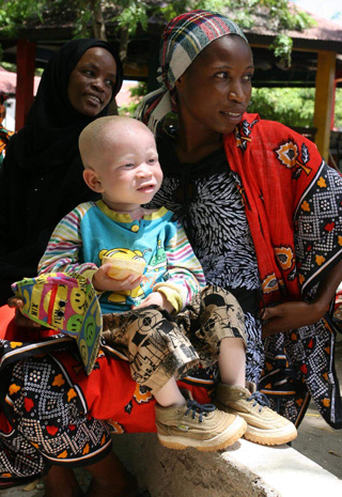 Bei Albinismus handelt es sich um eine Pigmentstörung. Der Haut fehlt der Farbstoff Melanin. In Tansania sind etwa 4000 Albinos registriert. Die Schätzungen der tansanischen Albino-Gesellschaft gehen allerdings von rund 170.000 Menschen aus. Albinos leiden in Tansania besonders unter den intensiven Sonnenstrahlen, einer von sechs erkrankt an Hautkrebs.