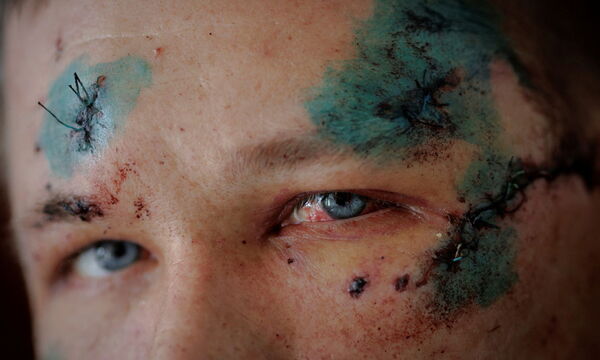 Eines von Zigtausenden Kriegsopfern: Sergej wurde bei einem Raketenangriff auf Charkiw verwundet. 