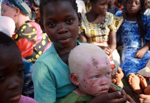 Über 50 Albinos sind bereits Ritualmorden zum Opfer gefallen. Auftraggeber der grausamen Verfolgung sind anerkannte Wunderheiler, die Gerüchte gestreut haben, dass die Albinokörperteile Glück bringen.
