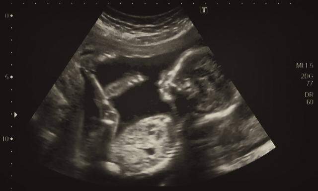 Ultraschallbild eines vier Monate alten Fötus.