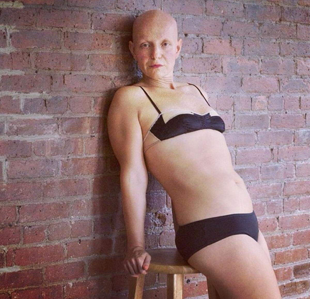 Rachel Fleit verlor mit vier Jahren alle Körperhaare und versuchte das lange Zeit zu verstecken. Mittlerweile hat sie kein Problem mehr, ihr Glatze zu zeigen.