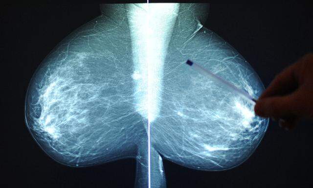 Die Mammografie wird durch den Bluttest ergänzt