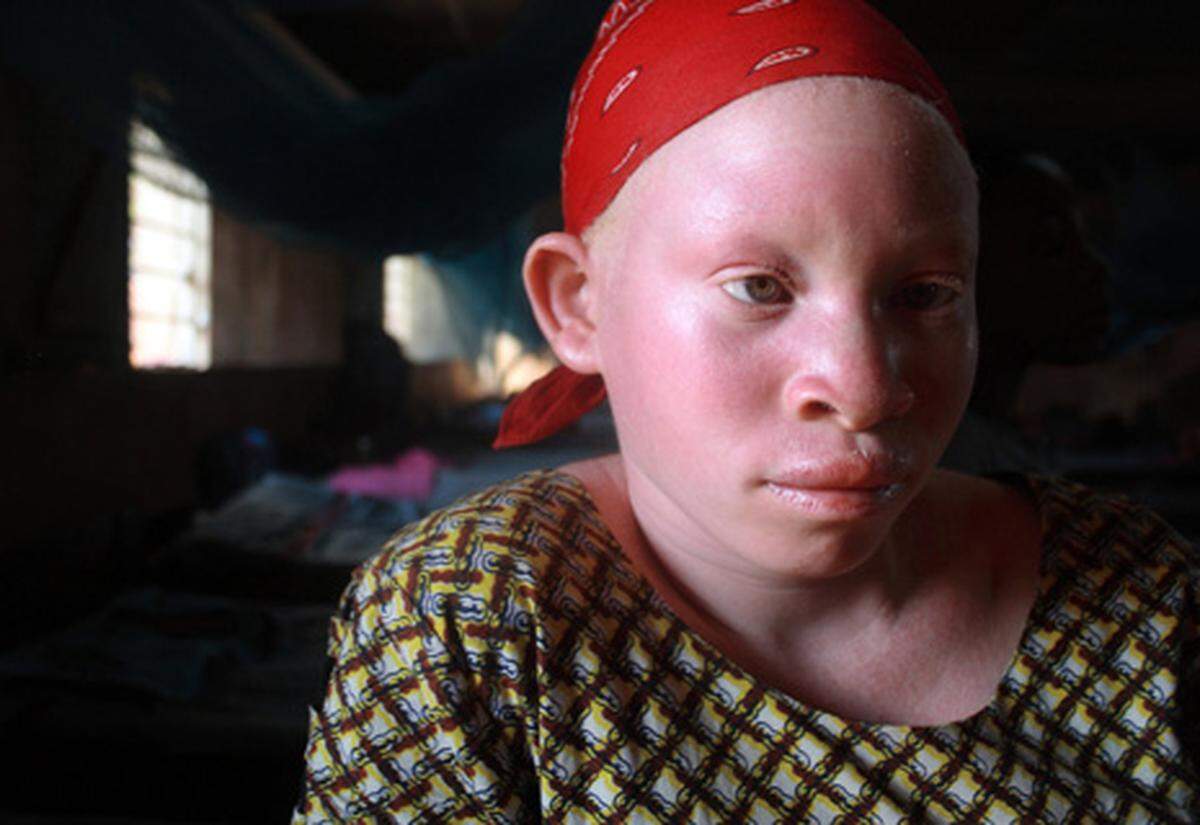 Vor rund zwei Jahr begannen die ersten Ritualmorde, bei denen Albinos Arme und Beine abgehackt wurden oder Albinojäger ihnen die Haut abzogen.