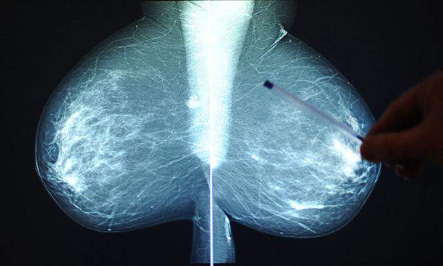 Brustkrebs ist nach Lungenkrebs die zweithäufigste Krebsart.
