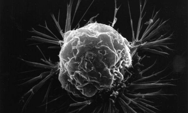 Eine Brustkrebszelle unter dem Rasterelektronenmikroskop.