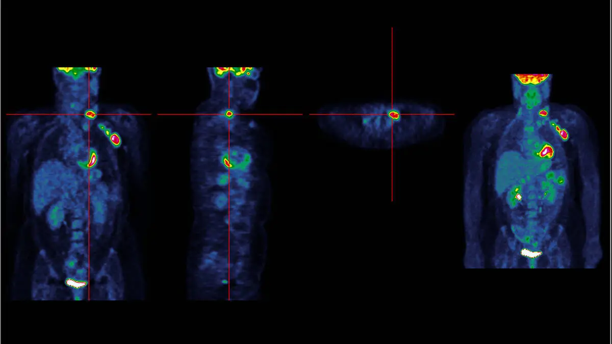 Marterbauer-macht-Krebsdiagnose-ffentlich-Was-ist-ein-Lymphom-premium-