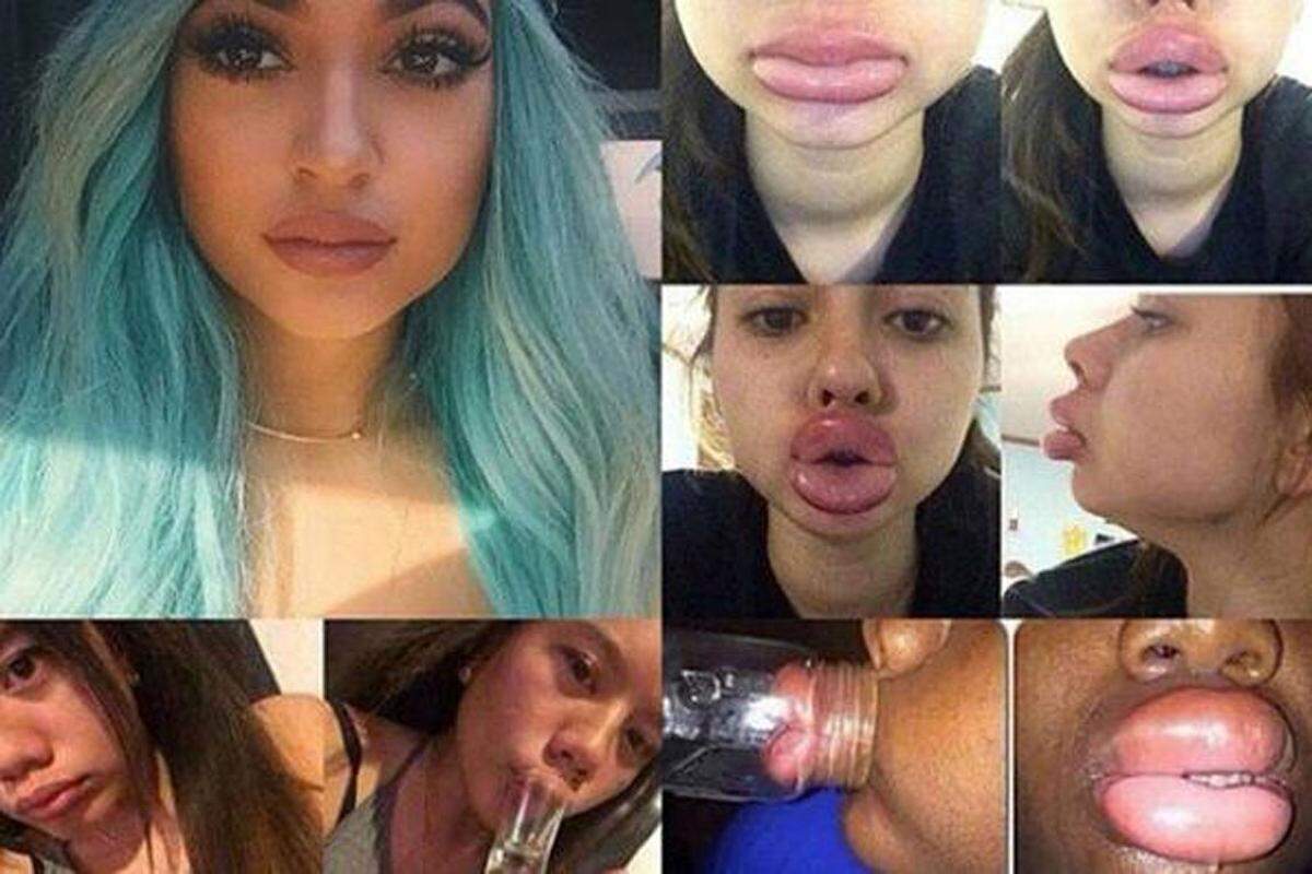 Ziemlich verstörend war dieses soziale Experiment, so volle Lippen wie Kylie Jenner (links oben) via Vakuum zu bekommen. Wie das Kunststück wirklich funktioniert, weiß aber nur Jenners Chirurg allein.