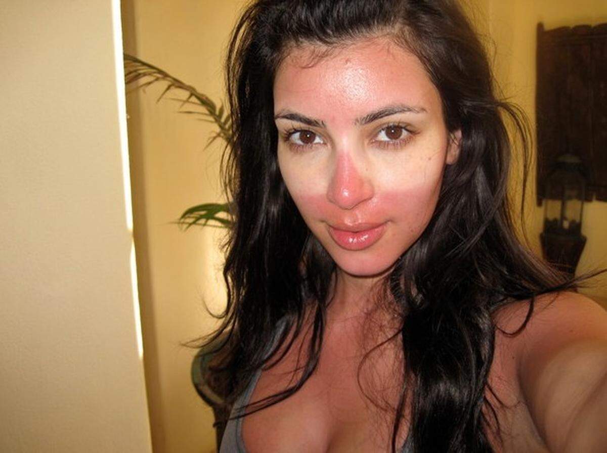 Sonnenbrand sollte man aufgrund von Folgeschäden nicht auf die leichte Schulter nehmen. Ein- und vor allem Nachcremen ist unerlässlich. Kim Kardashian verabsäumte dies, als sie in der Sonne einschlief ...