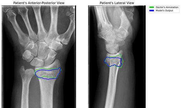 Bruch oder kein Bruch? Eine KI-Software kann die Diagnose vor allem bei schwer sichtbaren Handgelenkbrüchen verbessern. Eine klinische Untersuchung ersetzt sie nicht.