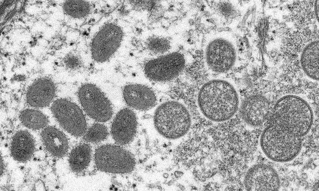 Diese elektronenmikroskopische Aufnahme zeigt reife, ovale Affenpockenviren und kugelförmige, unreife Virionen