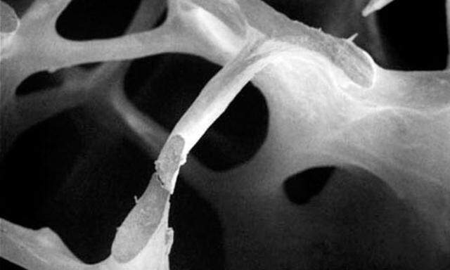 Knochen mit Osteoporose
