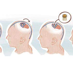 Dem Patienten wurde bei einer Operation ein Implantat in das Gehirn eingesetzt.