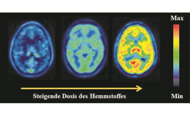 Das Tomografiebild zeigt, wie sich ein radioaktiv markiertes Medikament im Gehirn verteilt.