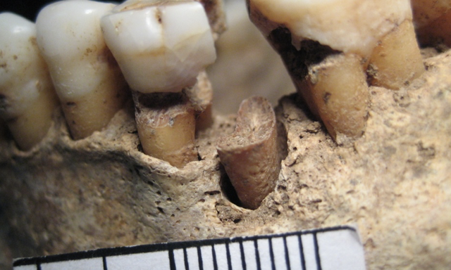 Karies an zwei benachbarten Zähnen bei einer Bestattung aus dem Frühmittelalter (6.–8. Jh. n. Chr.) aus Mannheim, Deutschland.