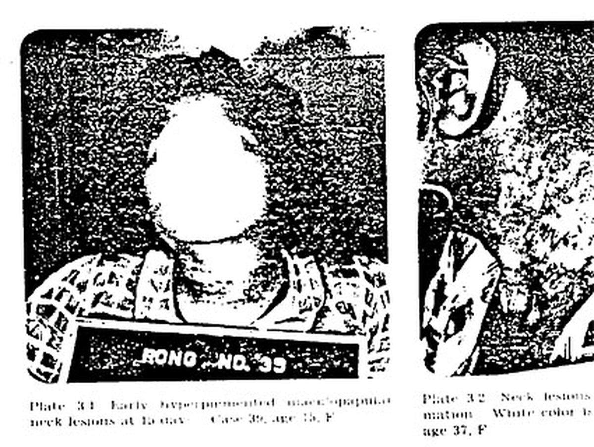 Die USA wählten das Bikini Atoll, um nach dem Kernwaffentest "Castle Bravo" auszuprobieren, wie sich radioaktiver Niederschlag auf Menschen auswirkt. Ziel war es unter anderem, geeignete Medikamente zu finden und zu testen. Rund 270 Menschen wurden dabei starker Strahlung ausgesetzt.Im Bild: Die Verletzungen der Testpersonen aufgrund der Strahlung wurden genau aufgezeichnet