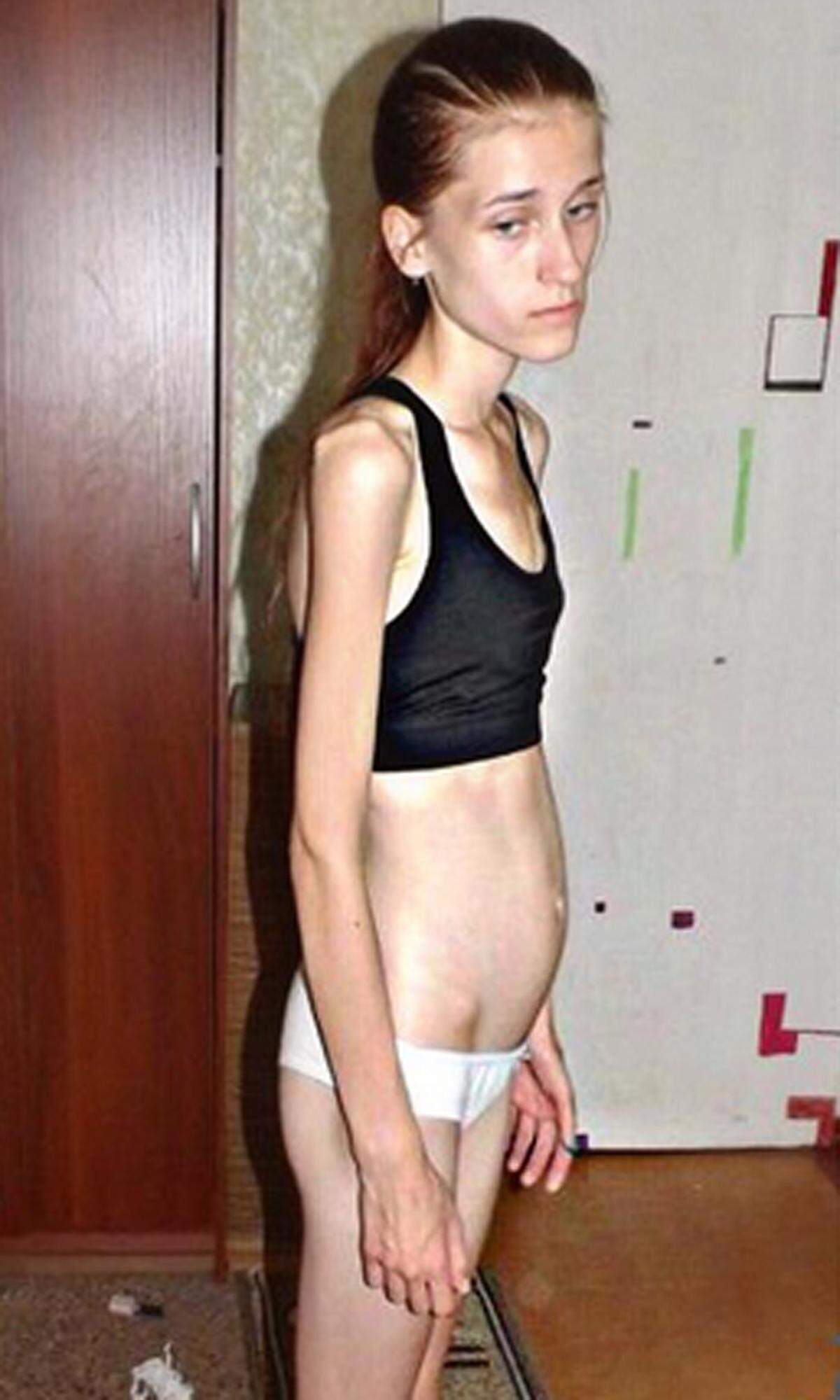 Die Russin litt in ihren Teenager-Jahren an Anorexia nervosa, Magersucht.