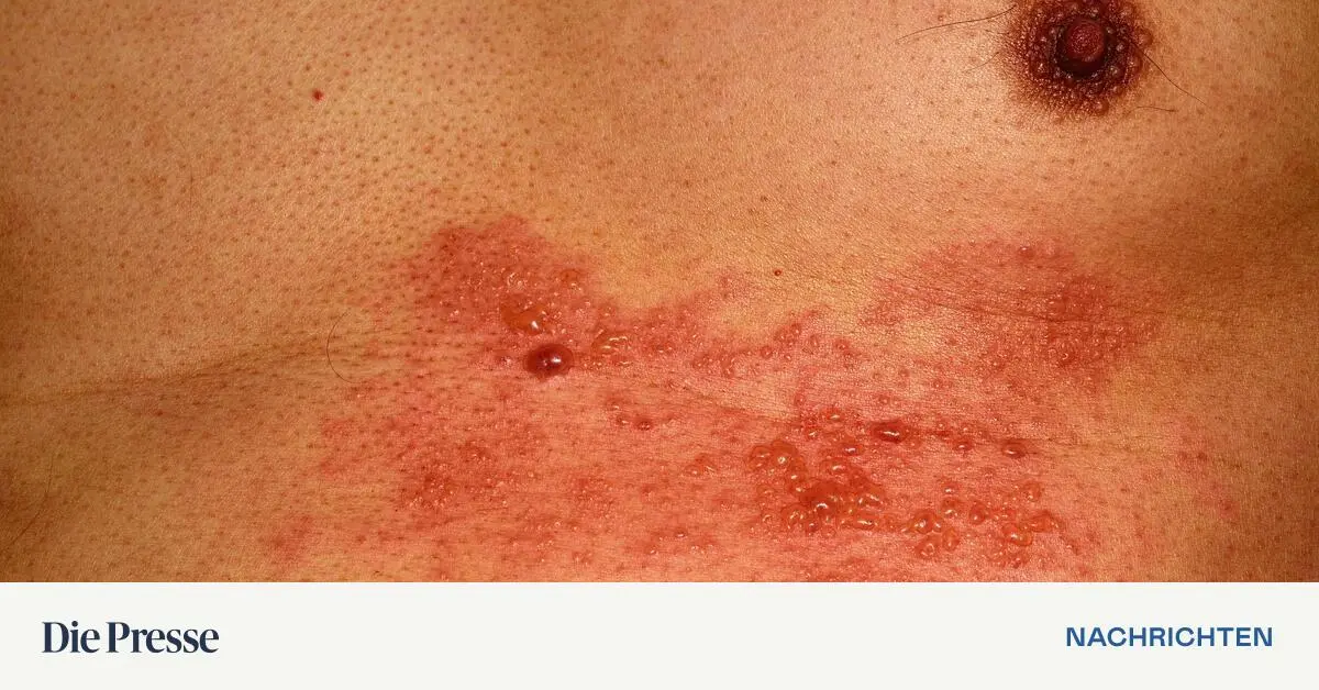 250-000-Impfdosen-gegen-G-rtelrose-werden-bis-Anfang-April-nachgeliefert